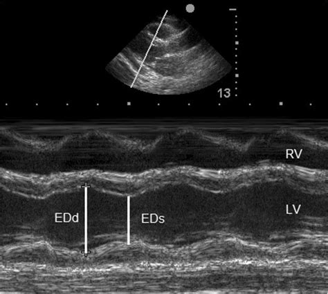 m mode echocardiogram ejection fraction